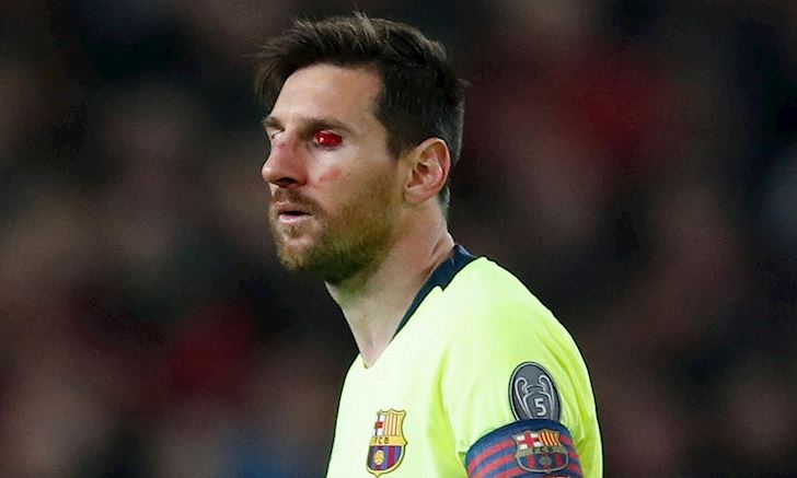Bị Smalling đánh trọng thương, Messi sắp phải đeo mặt nạ thi đấu?