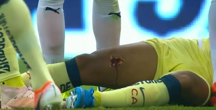 Cựu sao Barca bị đạp thủng đùi, gãy xương