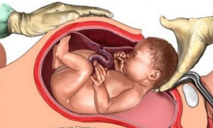 4 "di chứng" sau sinh mổ, nhiều mẹ chỉ phát hiện ra sau khi sinh con